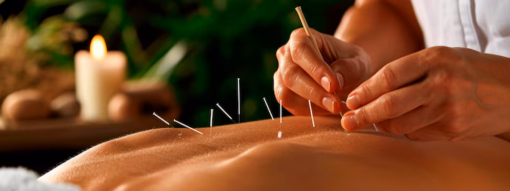 Acupuncture in Surrey